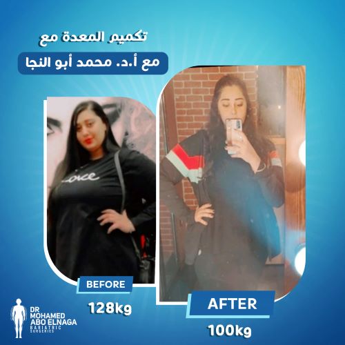 جدول الأكل بعد شهر من التكميم